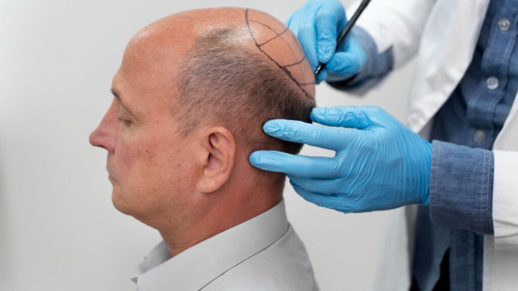 DHI Hair Transplant