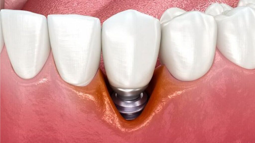 Dental Implant Surgery Tips and Common Mistakes