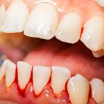 Effective Strategies to Maintain Healthy Gums and Prevent Bleeding